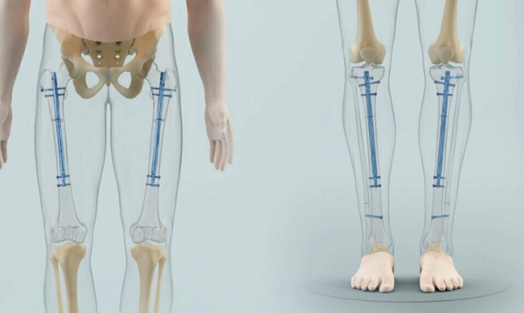 Expert Limb Lengthening Surgery by Dr. Nikhil S. Charde